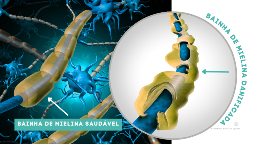 Detalhe em zoom de uma bainha de mielina danificada ilustrando o vazamento de impulsos elétricos